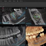 DEXIS OP 3D EX 10×11 – tomograf stomatologiczny 3D