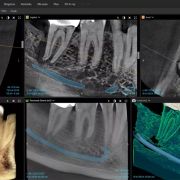 DEXIS OP 3D EX 10×11 – tomograf stomatologiczny 3D
