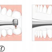 Woodpecker mikrosilnik endodontyczny  MOTOPEX z endometrem